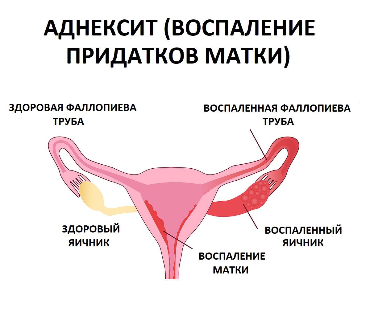 Лечение воспаления яичников у женщин | Симптомы и лечение воспаления женских яичников в Ижевске